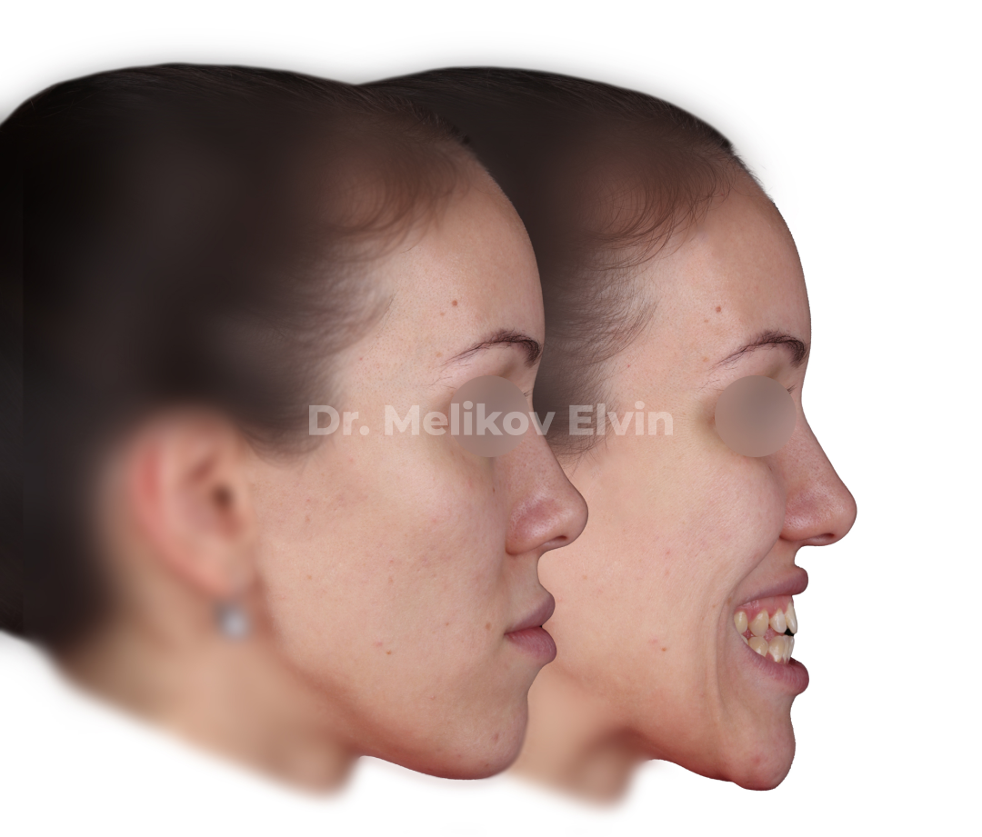 Мезиальный прикус