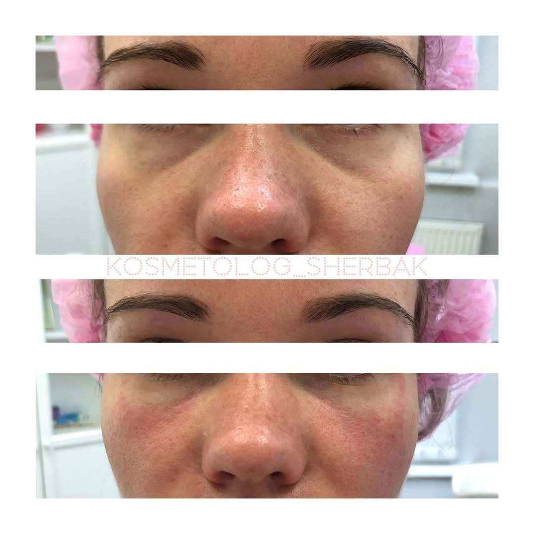 Контурная пластика лица в клинике PradusCOSMO, Санкт-Петербург. Естественный результат без эффекта переделанного лица