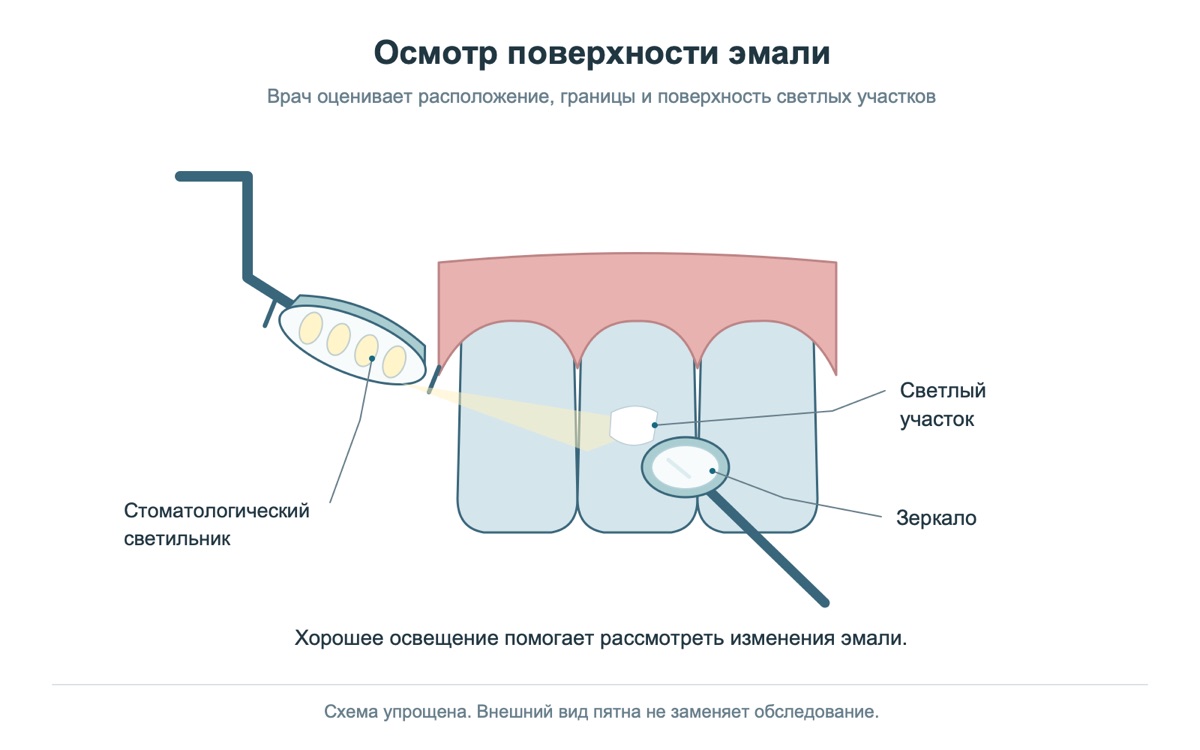 Оценка поверхности эмали на стоматологическом осмотре