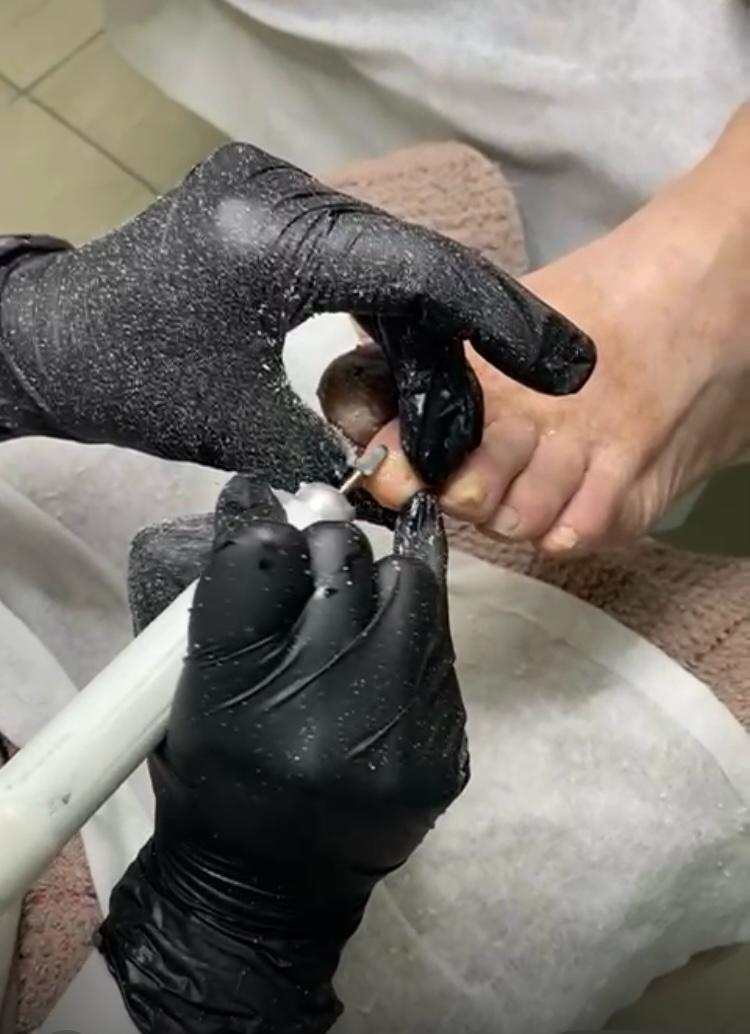 Аппаратная обработка грибка ногтя