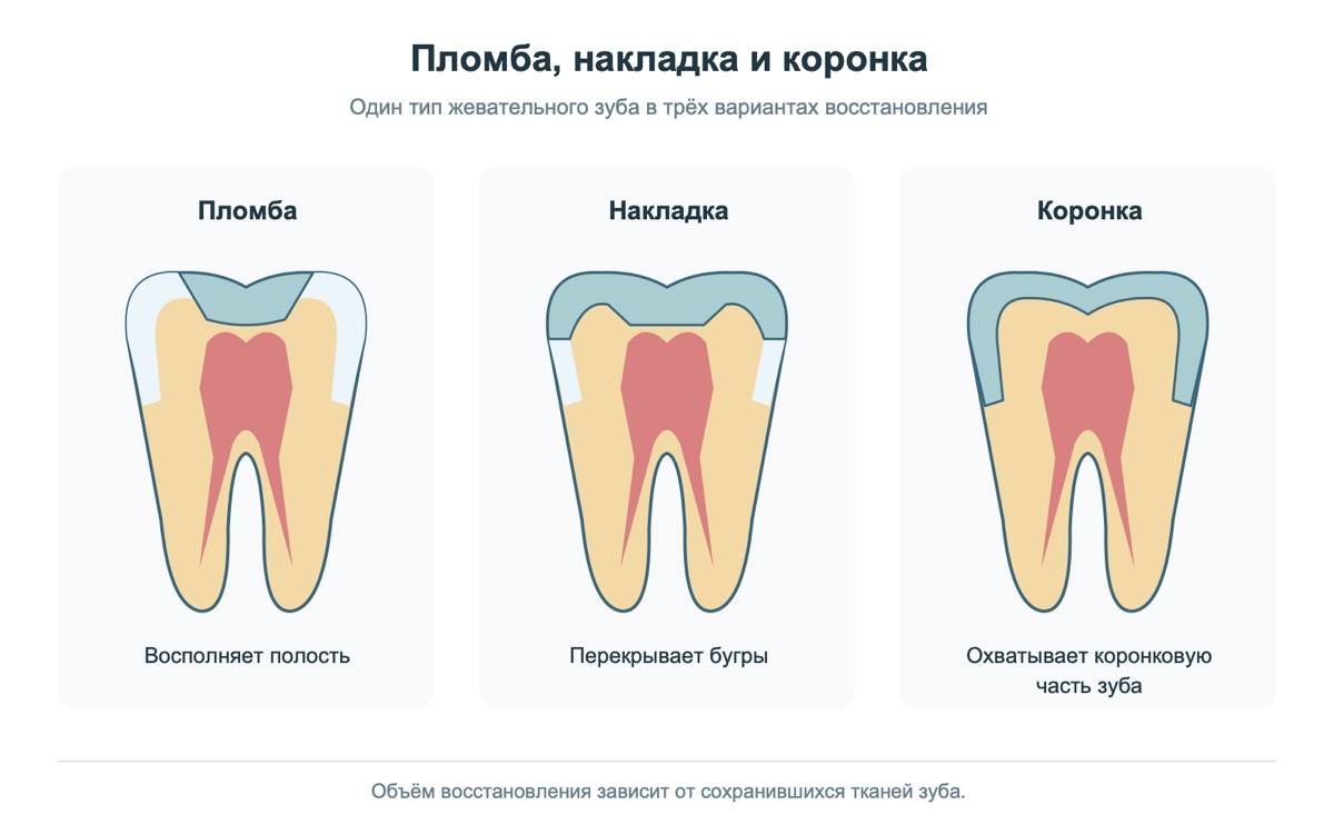 Пломба, накладка и коронка закрывают разные участки зуба
