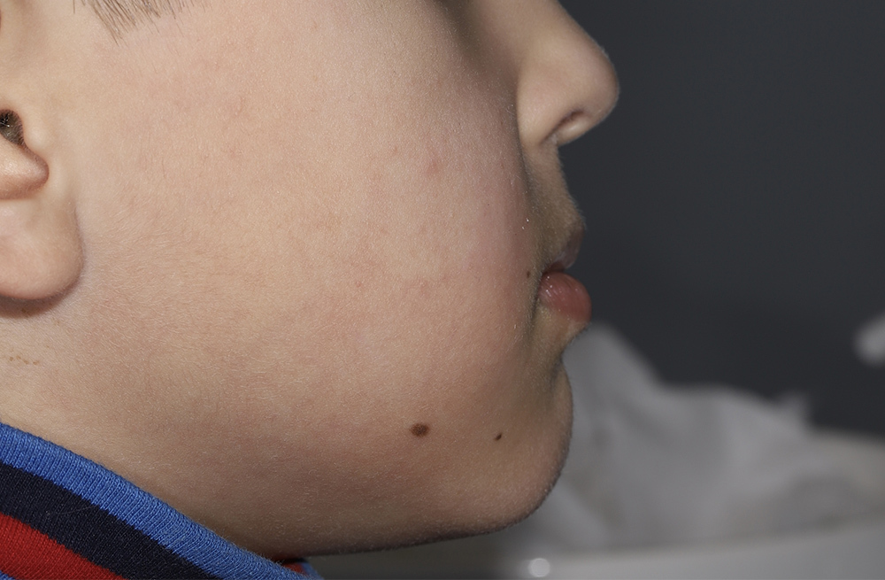 Комплексная коррекция мезиальной окклюзии у ребенка с решением проблем дыхания