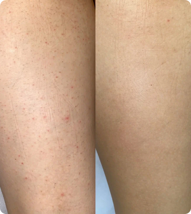 лазерная эпиляция ног