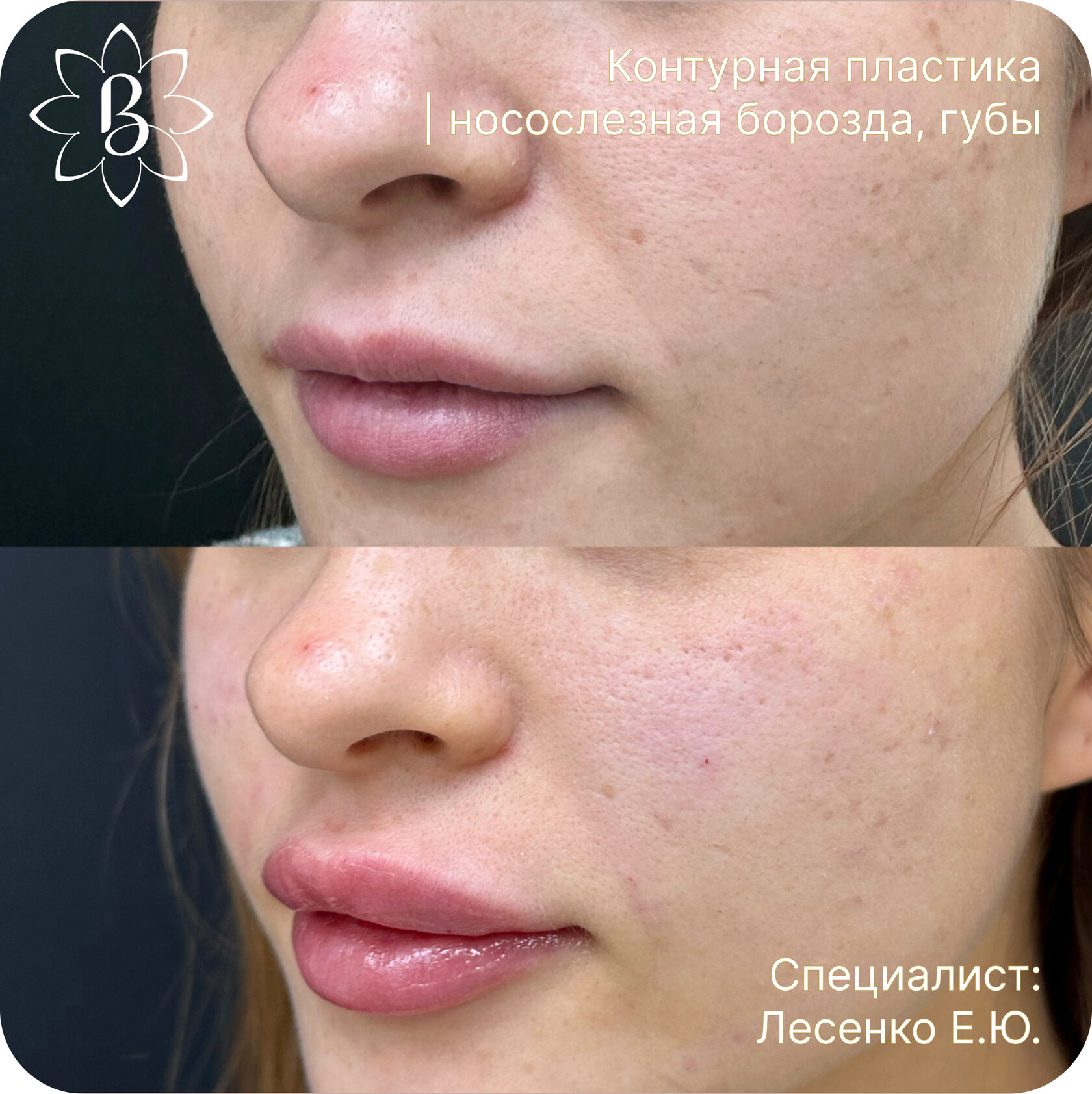 Александритовая лазерная эпиляция