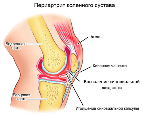 Блокада коленного сустава Дипроспаном