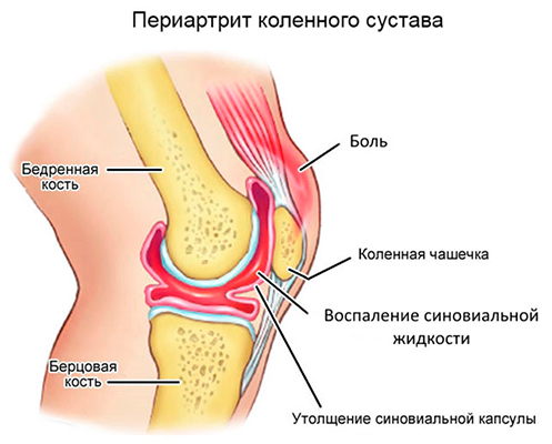 Блокада С Дипроспаном