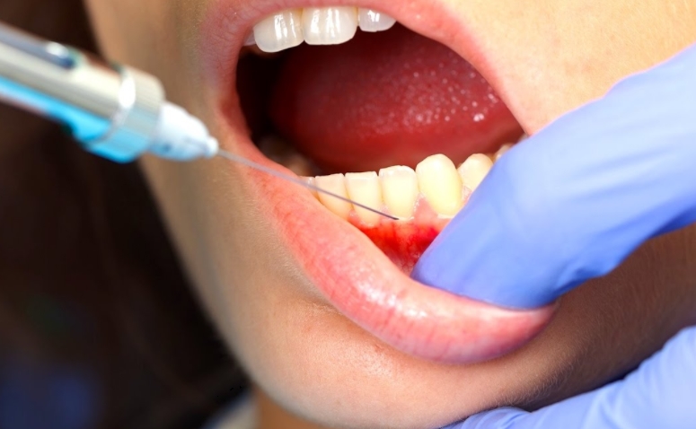 Эфект от применения гиалуроновой кислоты в стоматологии | MedicalCase
