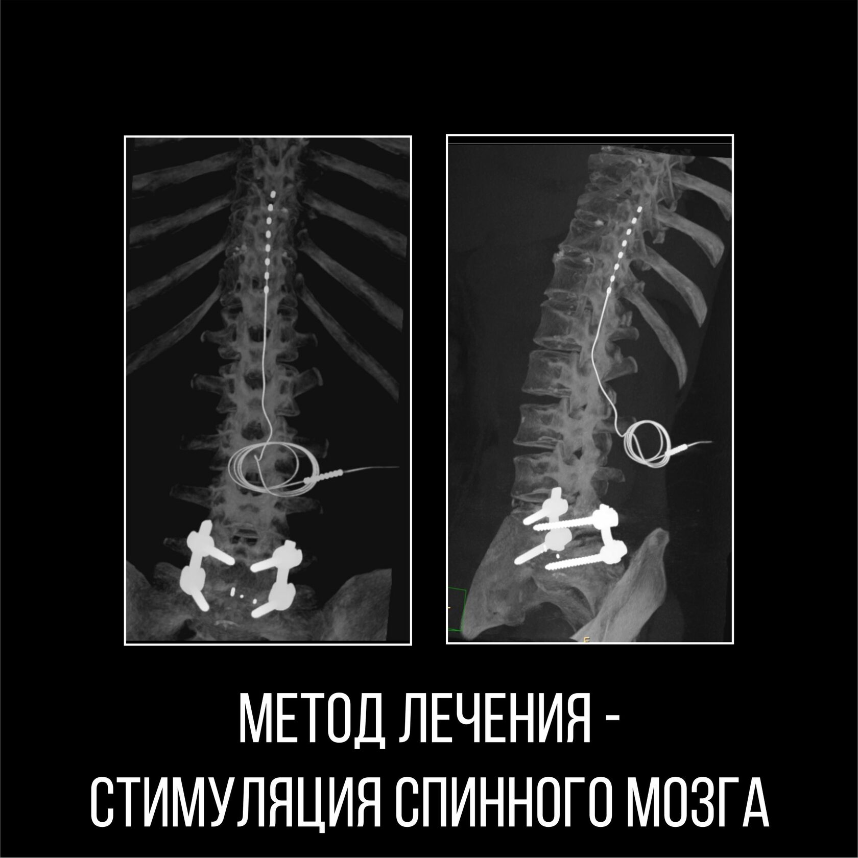 Стимуляция спинного мозга