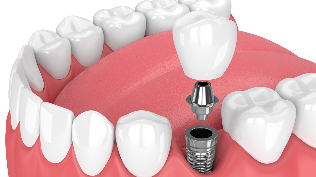 Имплантация зубов в Калининграде выгодно, беспроцентная рассрочка