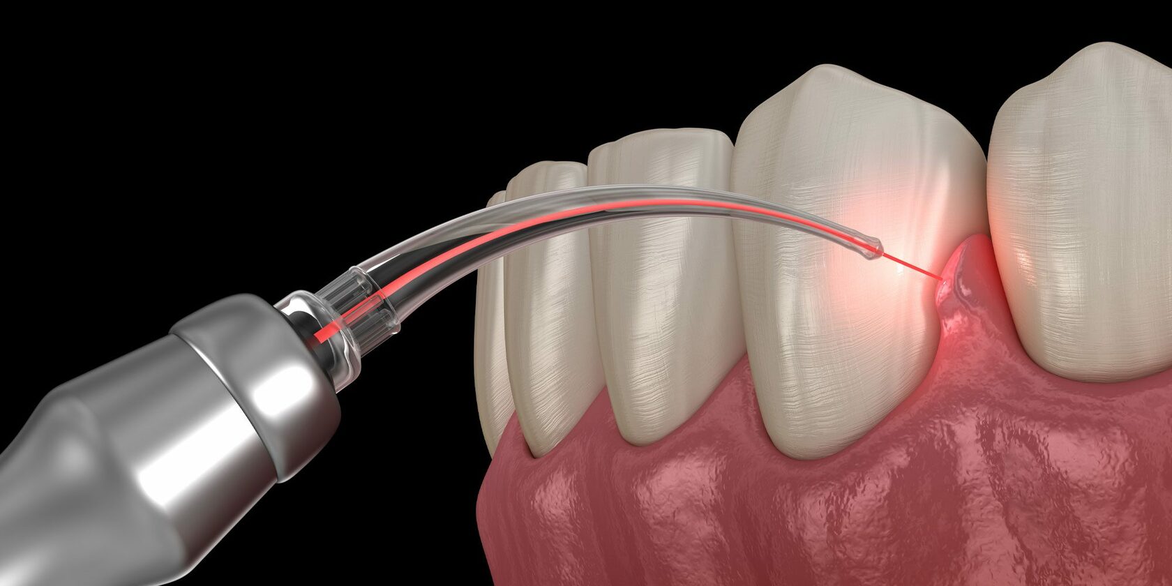Кровоточивость десен при чистке зубов