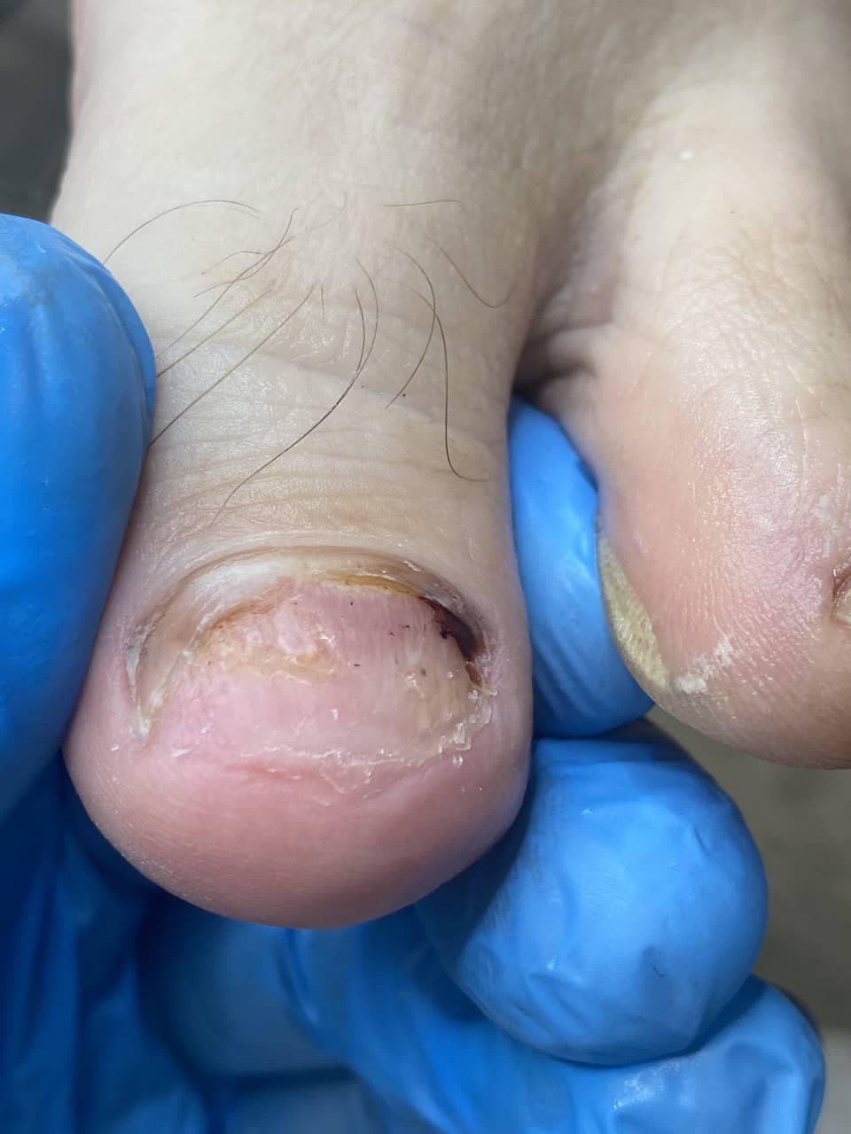 травма ногтя