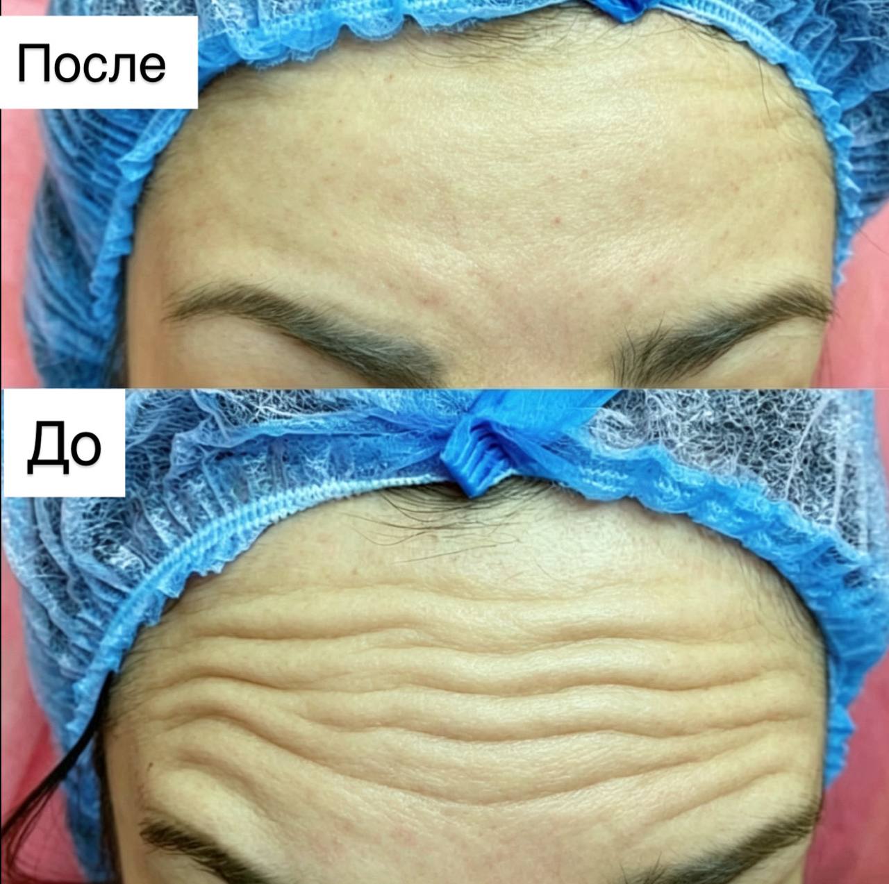 Ботокс