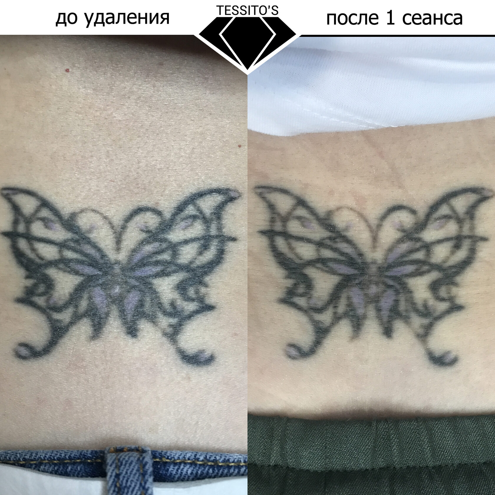 Удаление татуировок и перманентного макияжа – Confido Meditsiinikeskus