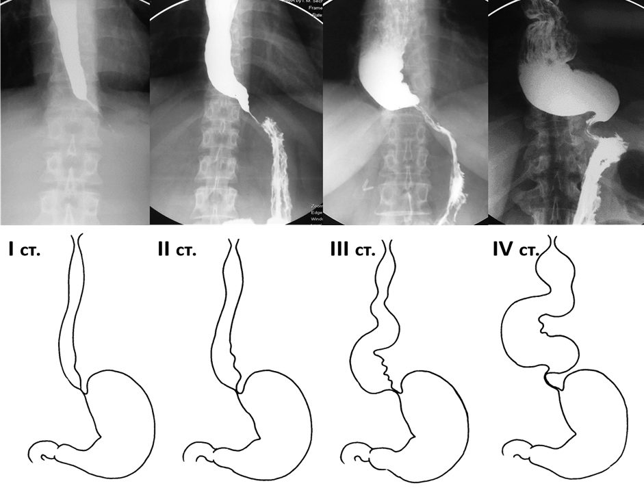 Ахалазия кардии презентация