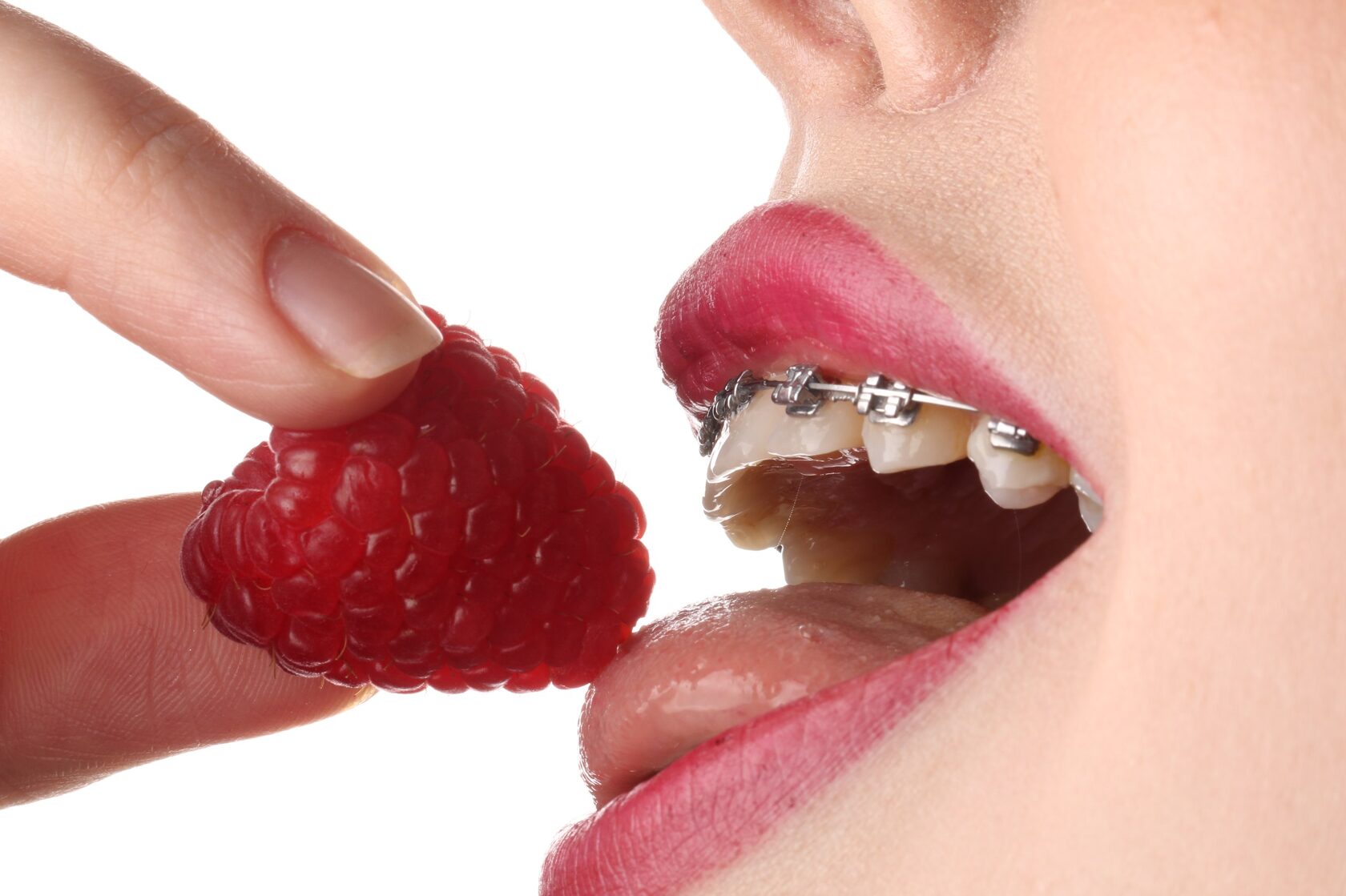 Установка брекетов в Abiclinic Москва