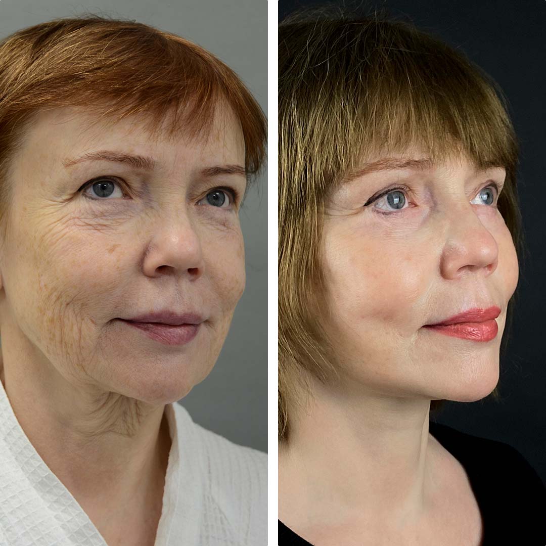 подтяжка лица фото до и после