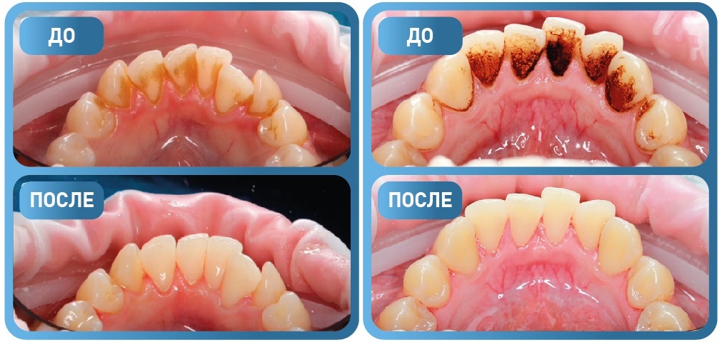 Чистка зубов от камня и налета фото до и после
