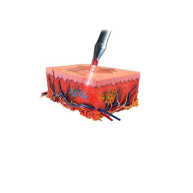 ND YAG Q-switch лазер для удаления тату и татуажа