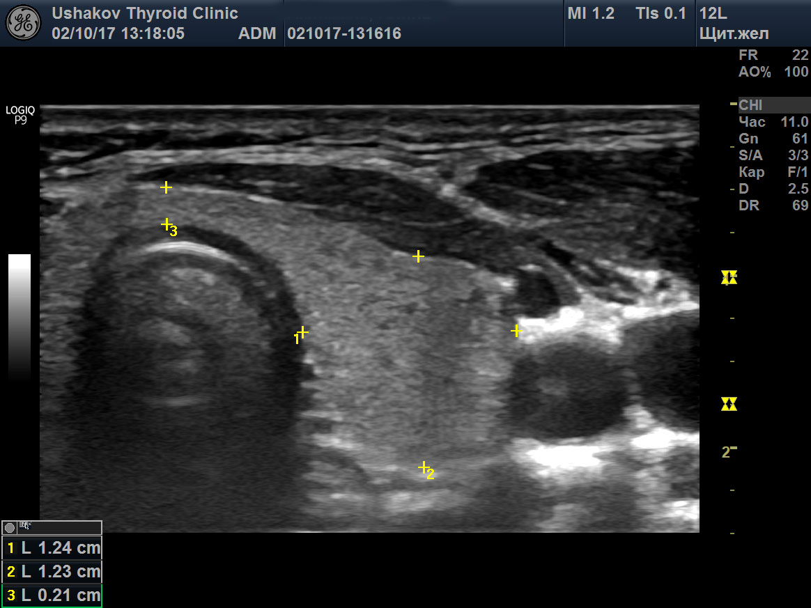 Щитовидная железа узи подготовка. УЗИ щитовидной железы Изранов. Расширенный фолликул щитовидной железы на УЗИ. Узел перешейка щитовидной железы УЗИ.