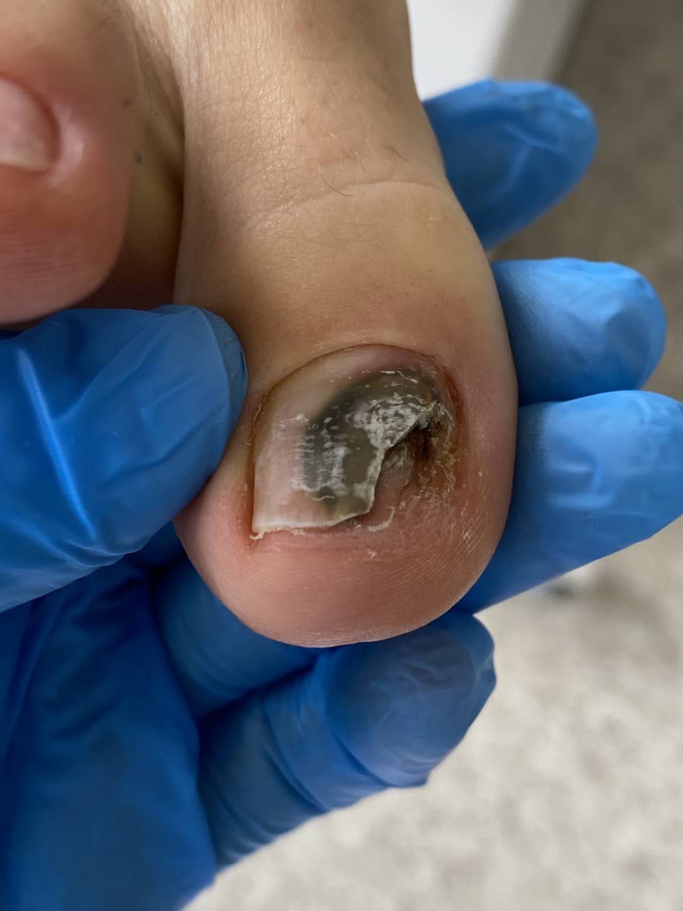 Протезирование ногтей