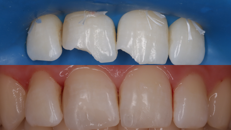 Реставрация зубов — цены и отзывы в Дербенте. Стоматология DK