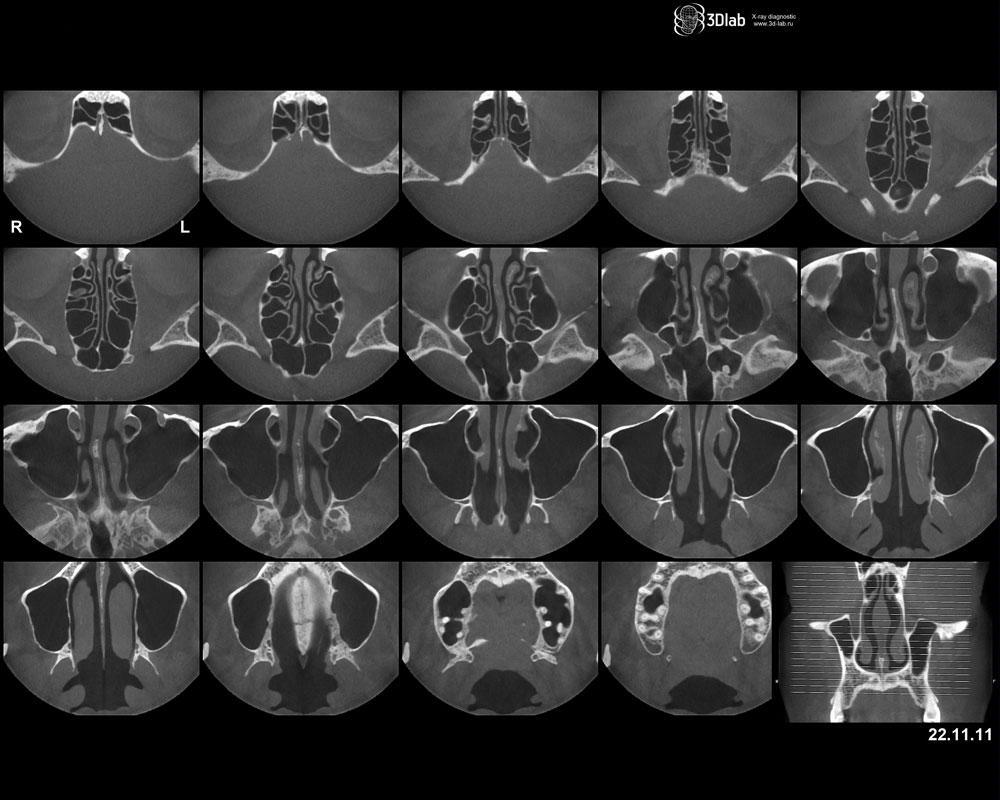 КТ пазух носа в Сургуте