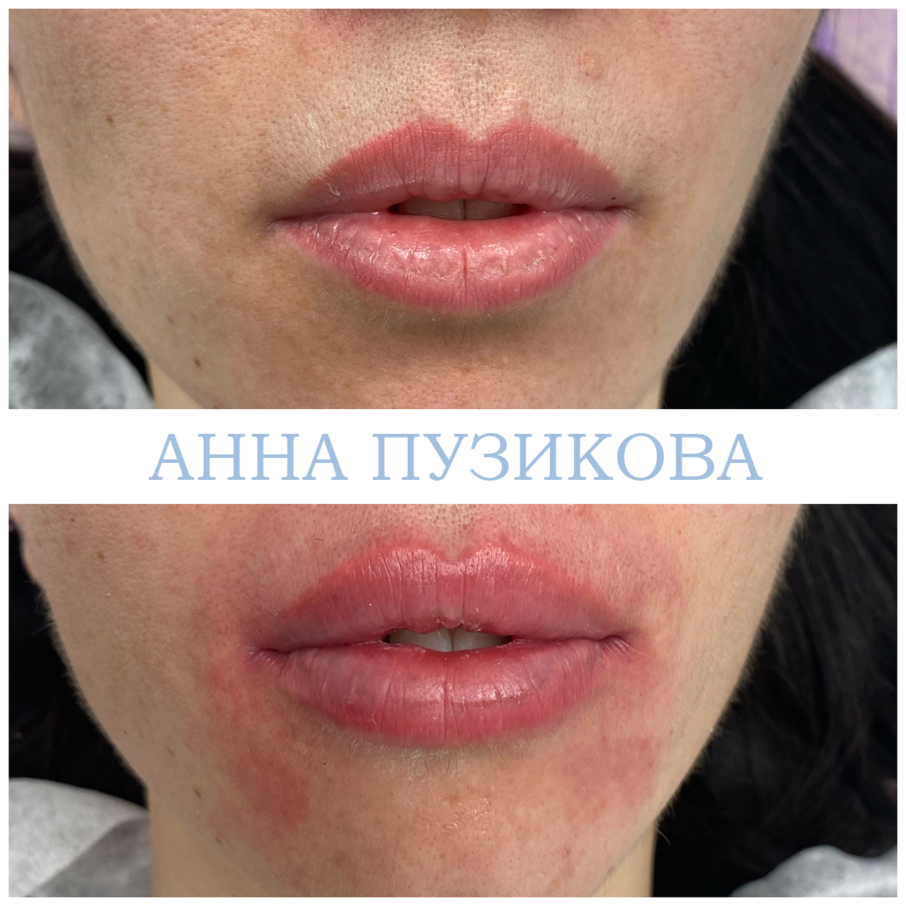 Контурная пластика губ гиалуроновым филлером — естественный результат без утраты пропорций. Косметолог Пузикова Анна Анатольевна, Санкт-Петербург.