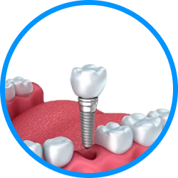 Установка имплантов в Дербенте. Имплантация при отсутствии одного зуба.