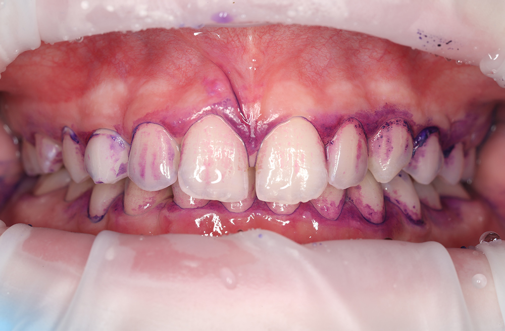 Чистка зубов Air Flow у ребёнка для профилактики кариеса