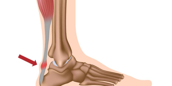 Повреждение сухожилий
