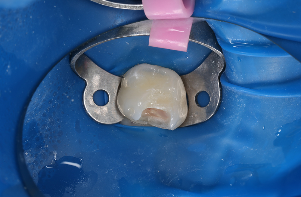 Плановое восстановление 65 зуба у 8-летней пациентки с применением Harmonize A2