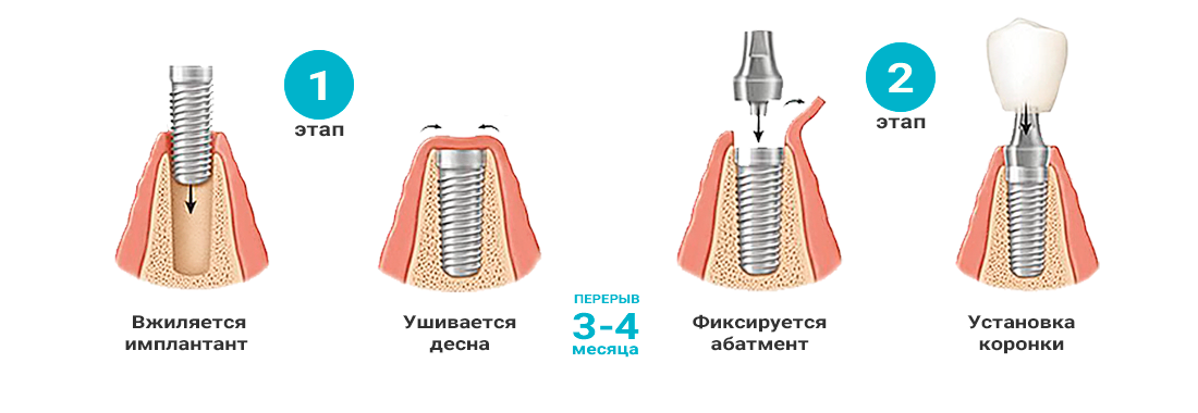 Имплант схема установки