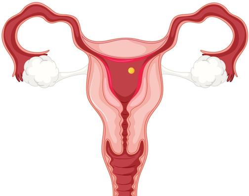 Поликистоз яичников (СПКЯ): симптомы, причины, лечение