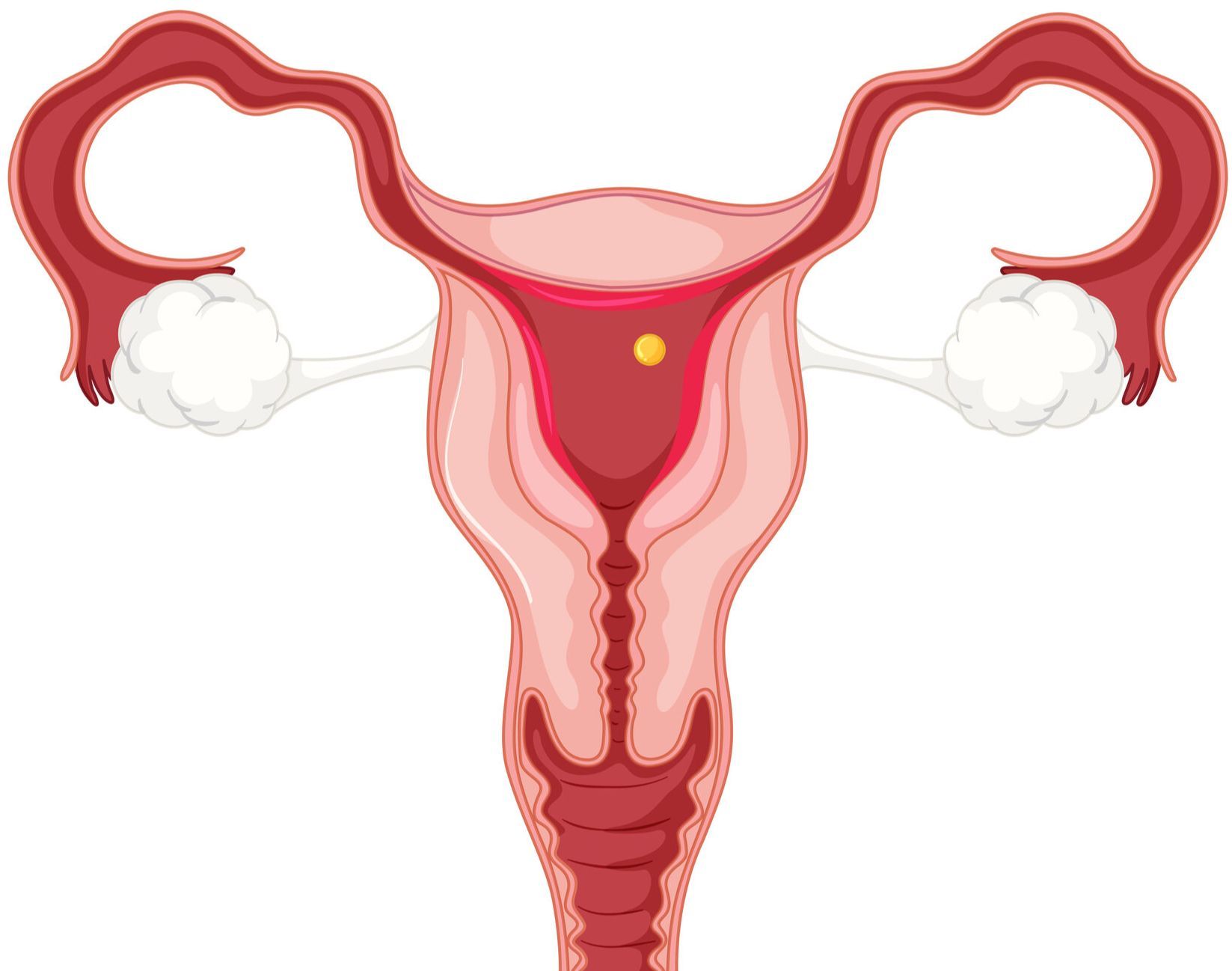 Патологии матки: как с ними родить и забеременеть? - Иркутский городской перинат