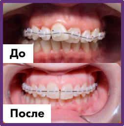 Установка имплантов в Дербенте. Имплантация при отсутствии одного зуба.