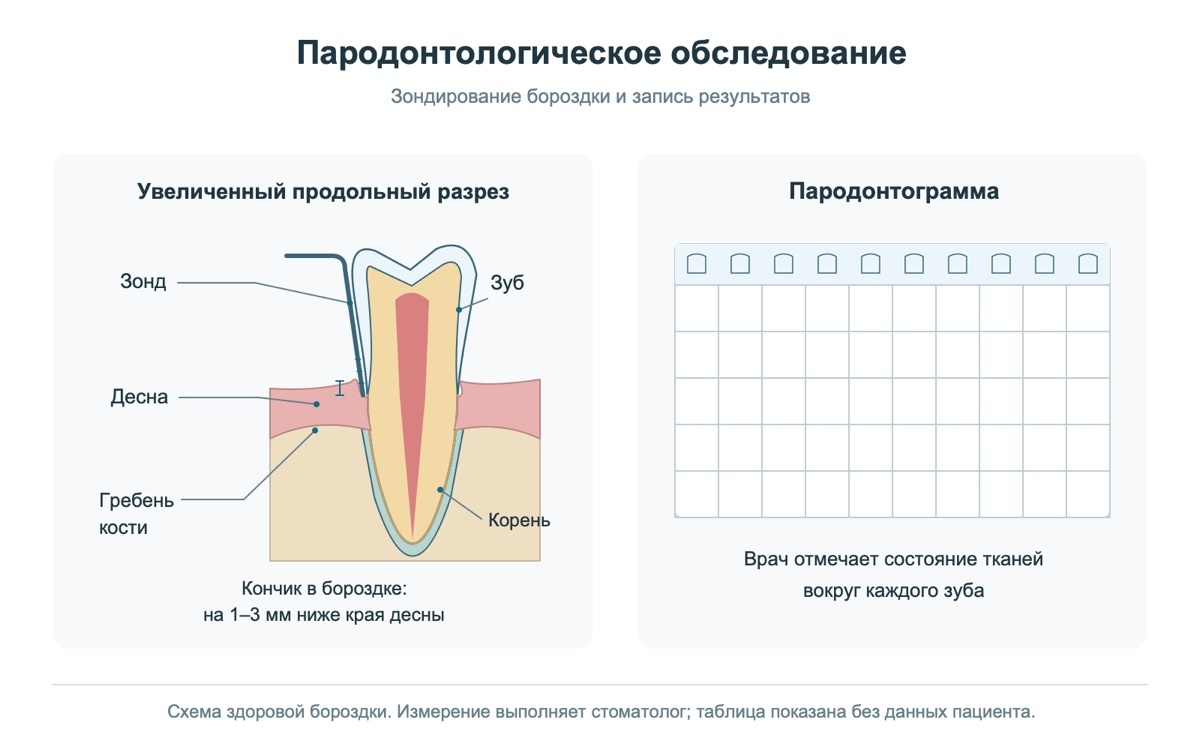 Зонд в десневой бороздке и схема пародонтограммы