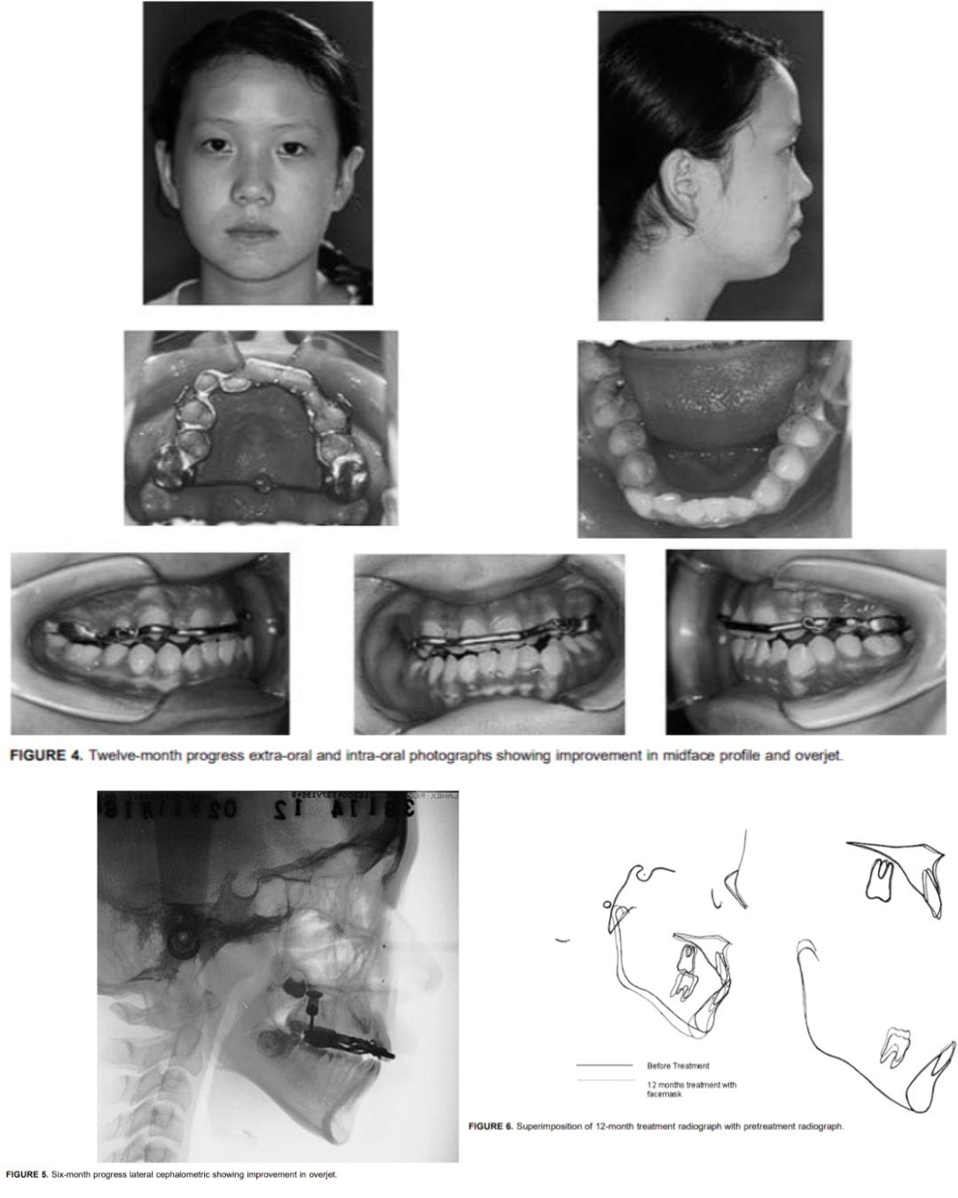 Stage showing the corrected sagittal relationship before finishing — photo 8 of 10