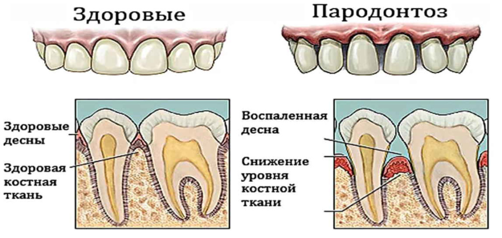 парадонтоз