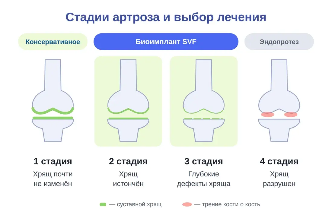 Стадии артроза коленного сустава: биоимплант SVF показан на 2–3 стадии