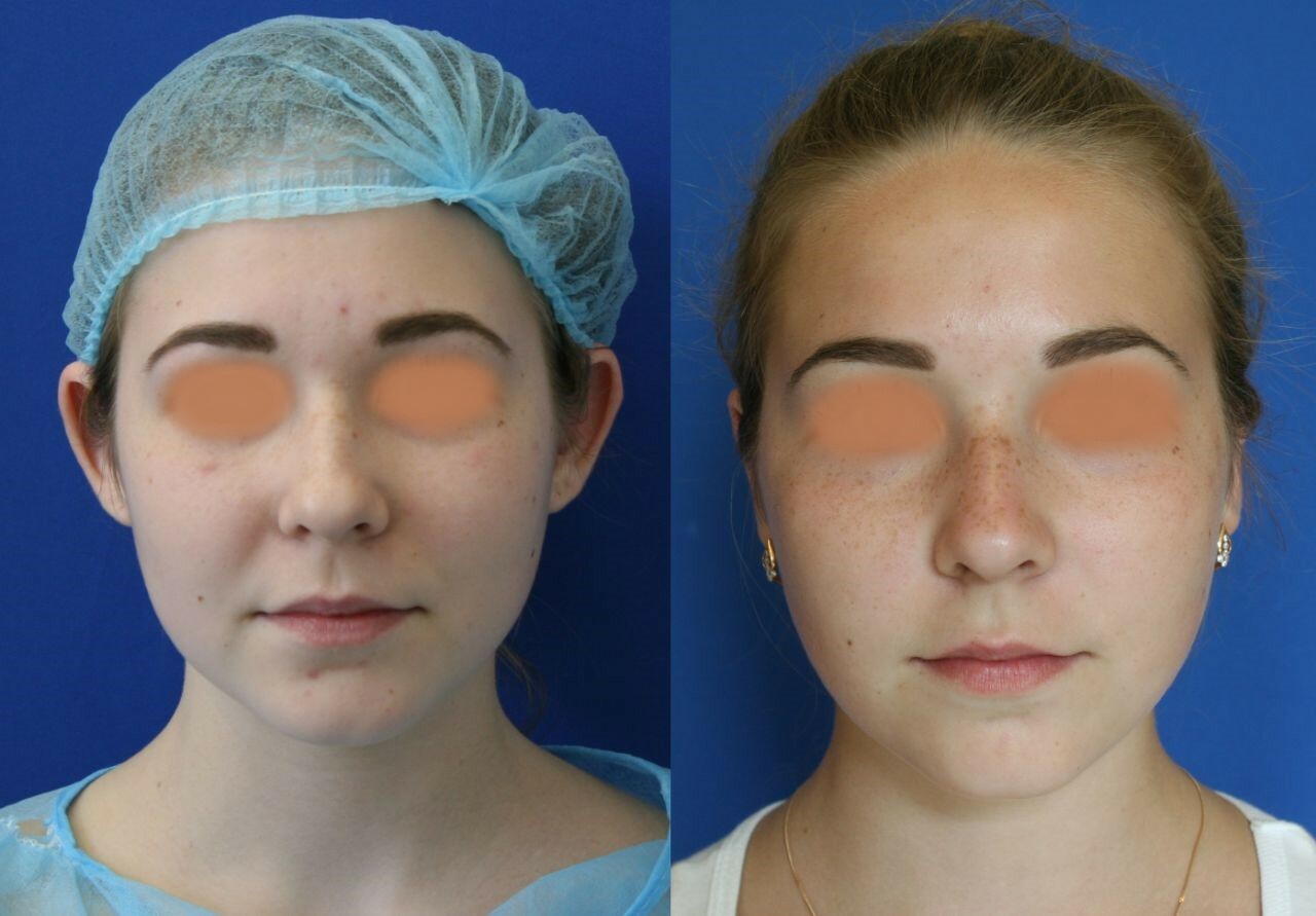 пластическая хирургия графические картинки. хирургическая косметология. канал пластический хирург. нижняя блефаропластика трансконъюктивальная. блефаропластика в усть-каменогорске в евромеде.