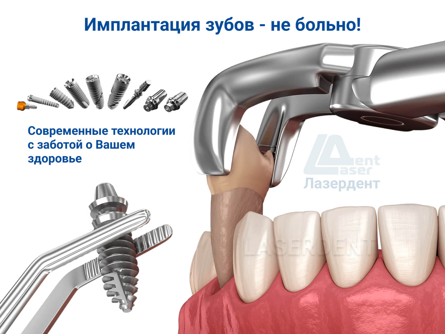Удалить вставить зубы. Зубной имплант Impro. Вставить зуб имплант цена. Имплантация зубов реклама.