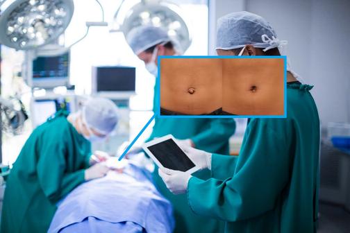 Пластика пупка после родов, операций: цена умбиликопластики в Москве