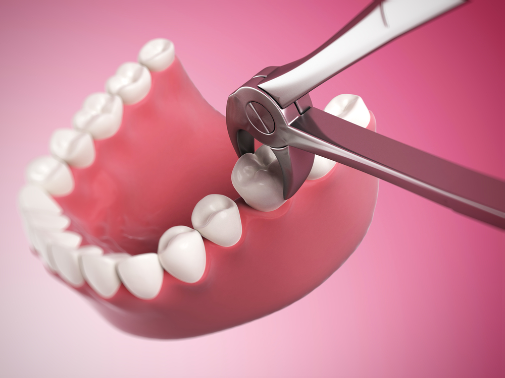 Зубная боль при накусывании – абсцесс
