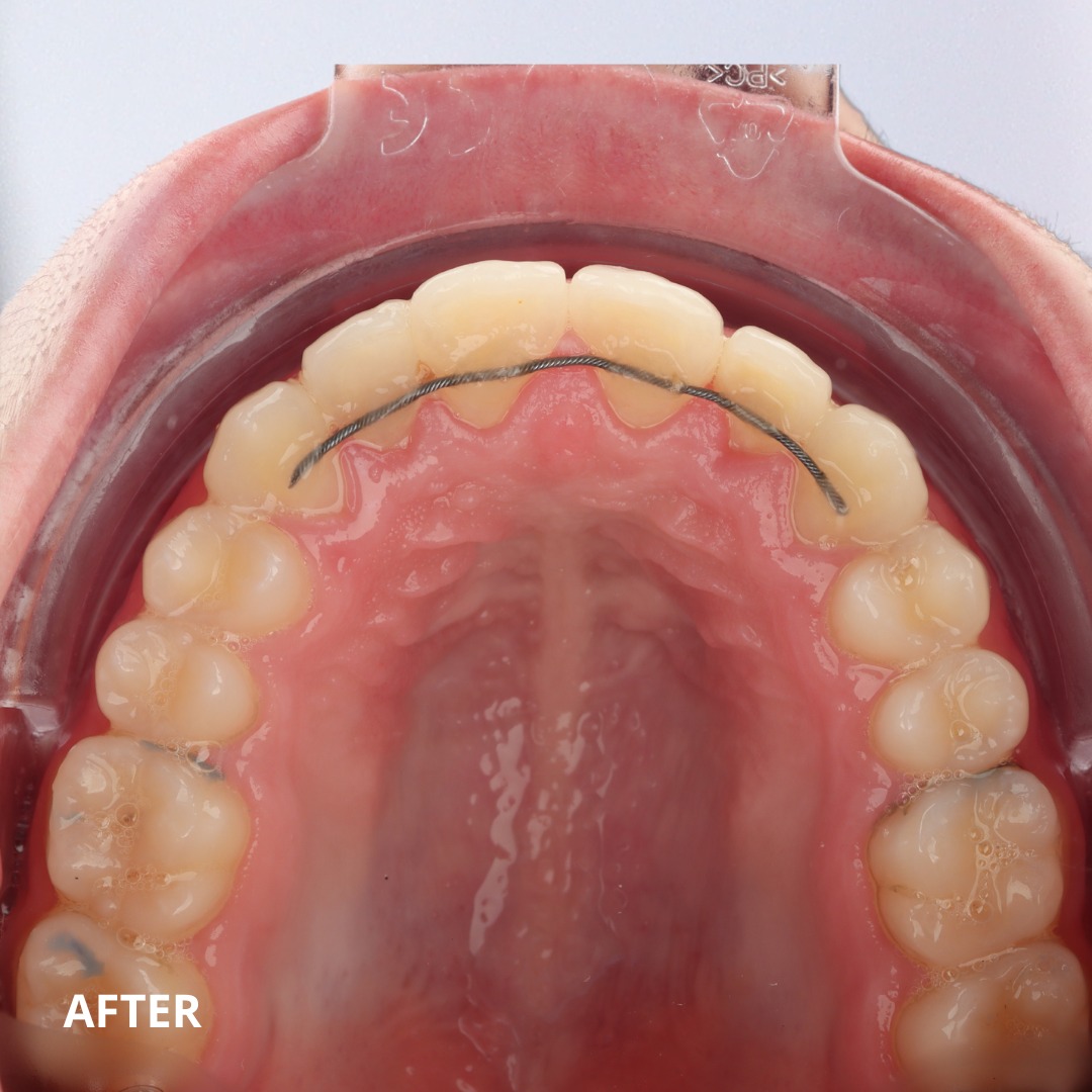After treatment: resolved crowding and improved arch width following MARPE and Damon bracket therapy — photo 3 of 3