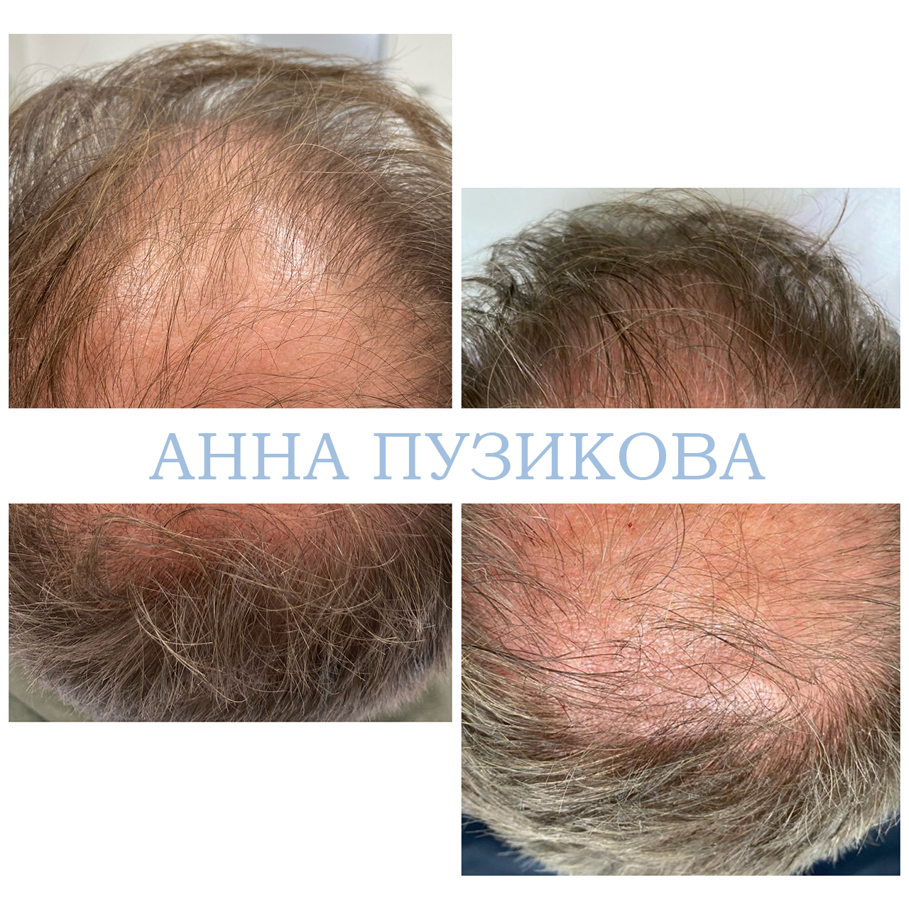 Результат лечения выпадения волос: повышение густоты, укрепление корней и улучшение состояния кожи головы — Прадус СПб.