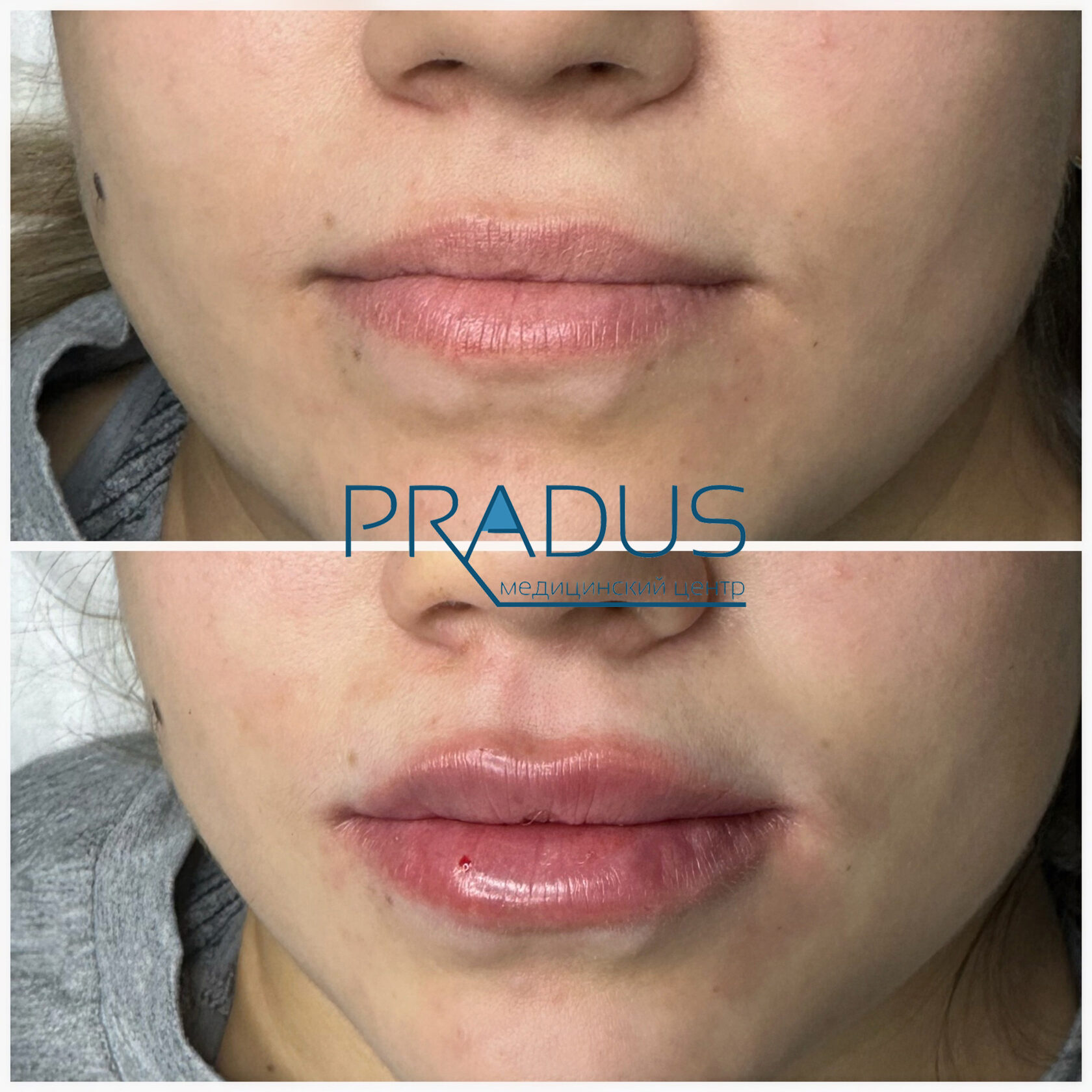 До и после контурной пластики губ. PradusCOSMO, Васильевский остров