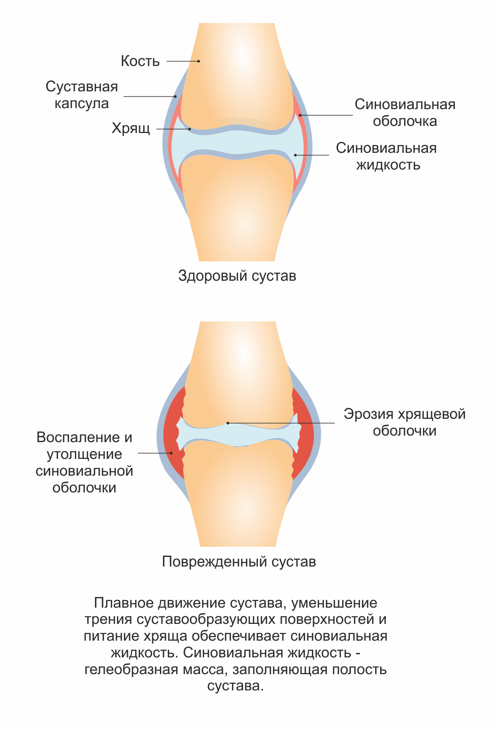 Гипертрофия суставных. Синовиальная мембрана и и суставная капсула. Синовиальная оболочка коленного сустава сустава. Суставная капсула синовиальная оболочка. Синовит синовиальная оболочка.