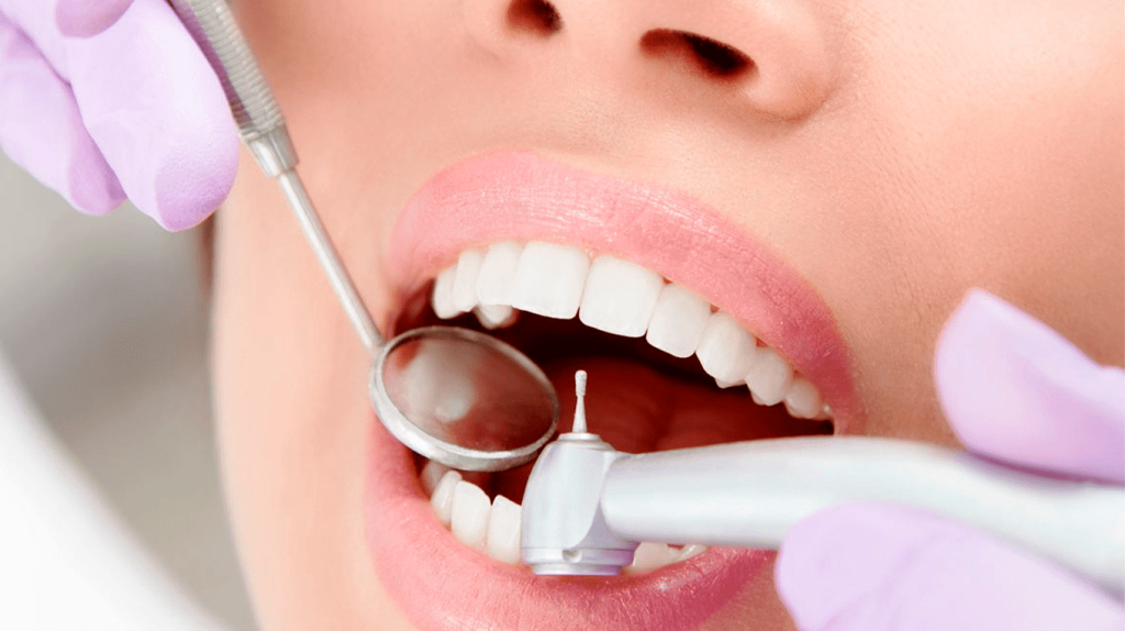 лечение кариеса Ульяновск