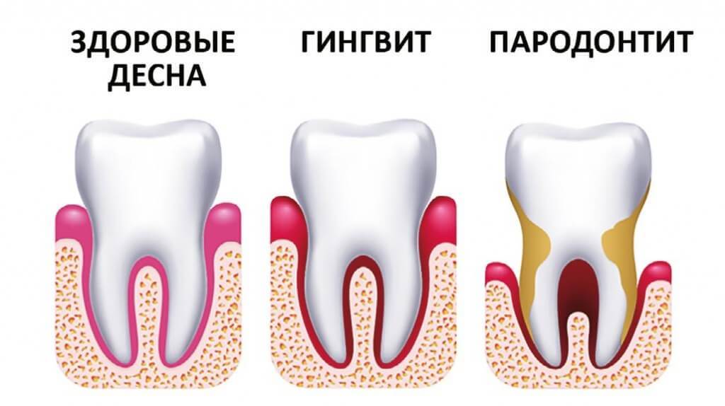 Картинка здорового зуба и больного