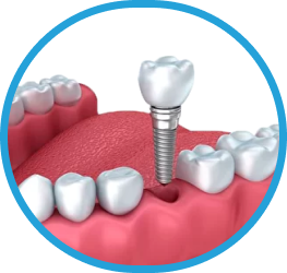 Установка имплантов в Дербенте. Имплантация при отсутствии одного зуба.